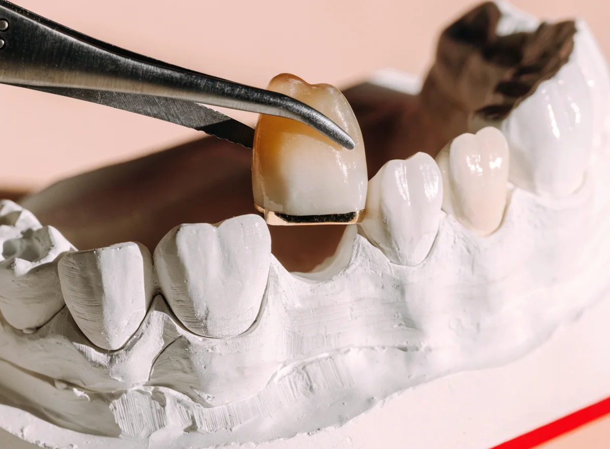 Dental crowns and bridges at Plux Dental, Taman Melawati (illustrative)