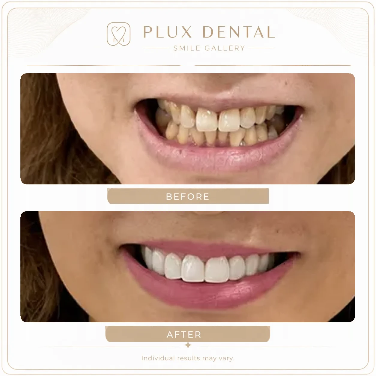 Before and after veneers, case 1: uneven, discoloured upper front teeth, then an even, brighter smile