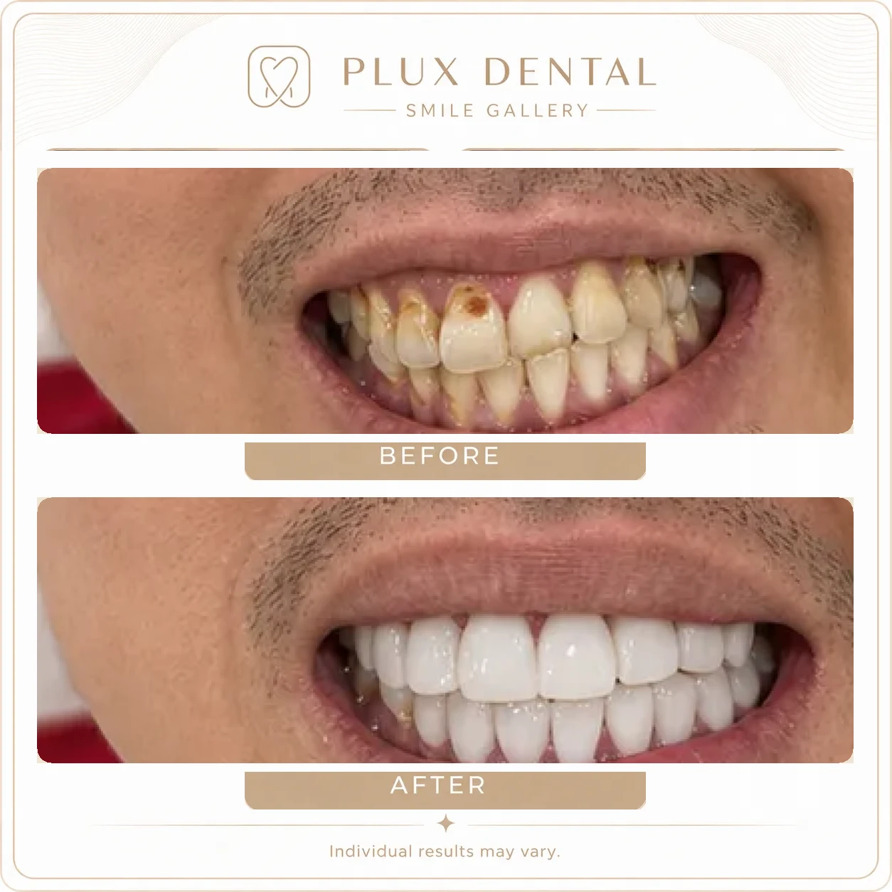 Before and after veneers, case 2: stained and chipped front teeth, then a uniform white smile
