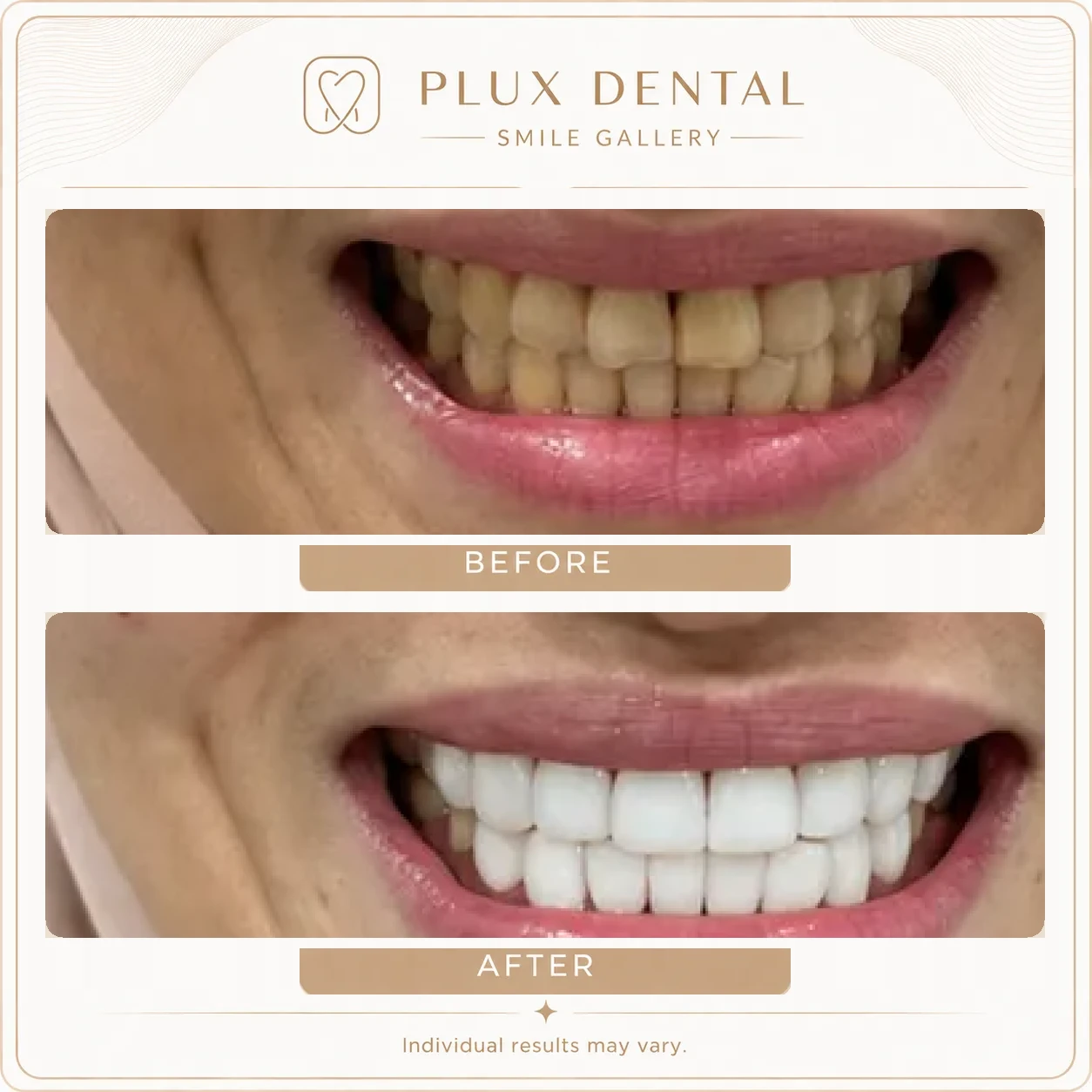 Before and after veneers, case 3: yellowed, crowded front teeth, then an aligned, brighter smile