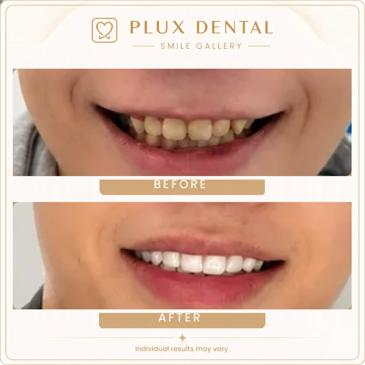 Before and after veneers, case 4: darkened, worn front teeth, then a natural-looking white smile