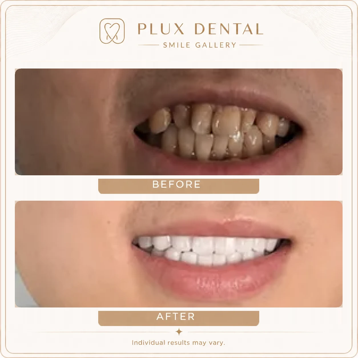 Before and after veneers, case 5: discoloured, uneven teeth, then an even, brighter smile