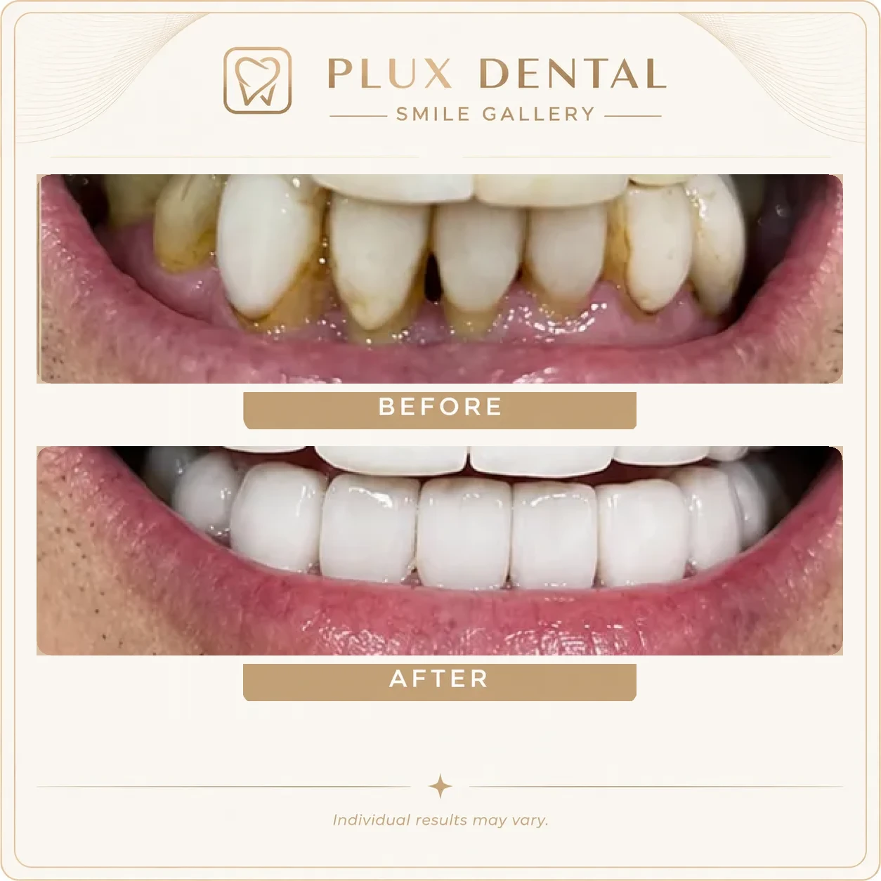 Before and after veneers, close-up: stained upper and lower front teeth, then a bright, even smile